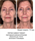 PEPTIDE CARBOXY THERAPY | Пептидная карбокситерапия - фото 9356